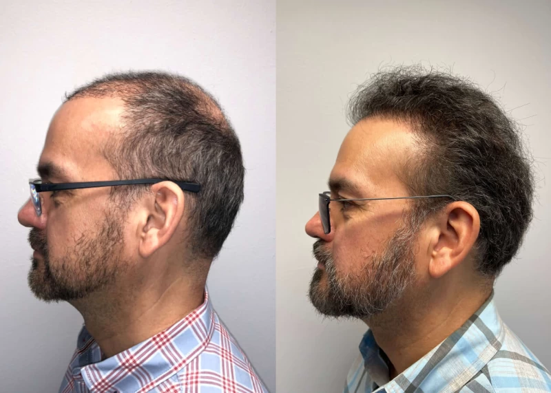 Patient p421 hair transplant before and after left view