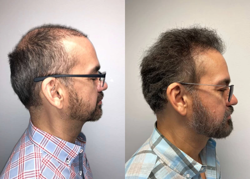 Patient p421 hair transplant before and after right view