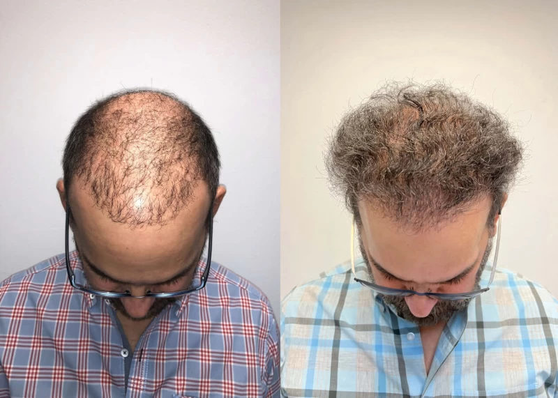 Patient p421 hair transplant before and after tilt view