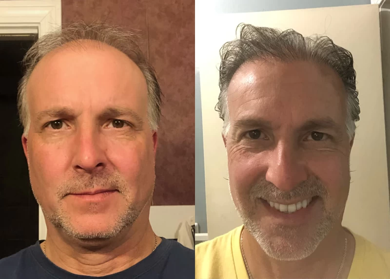Chris Hair Transplant Before and After