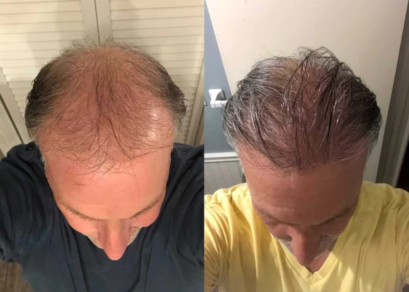 Patient p422 hair transplant before and after tilt view
