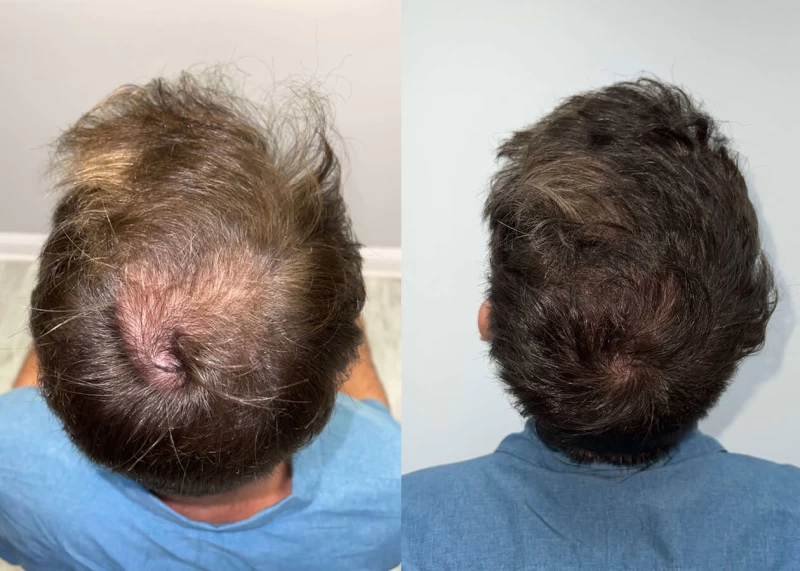 Patient p423 hair transplant before and after crown view