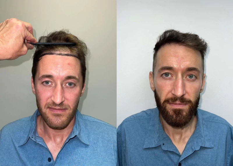 Mike Hair Transplant Before and After