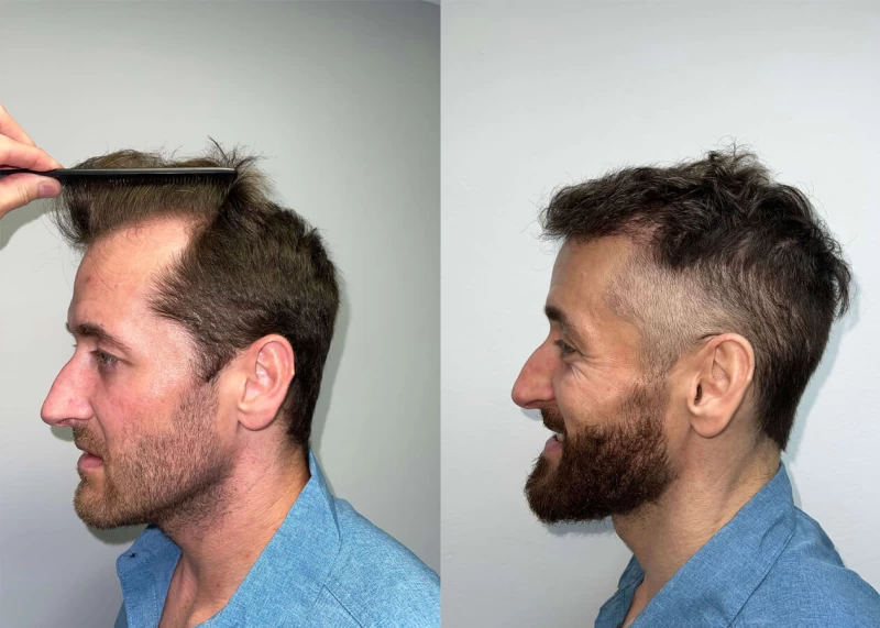 Patient p423 hair transplant before and after left view