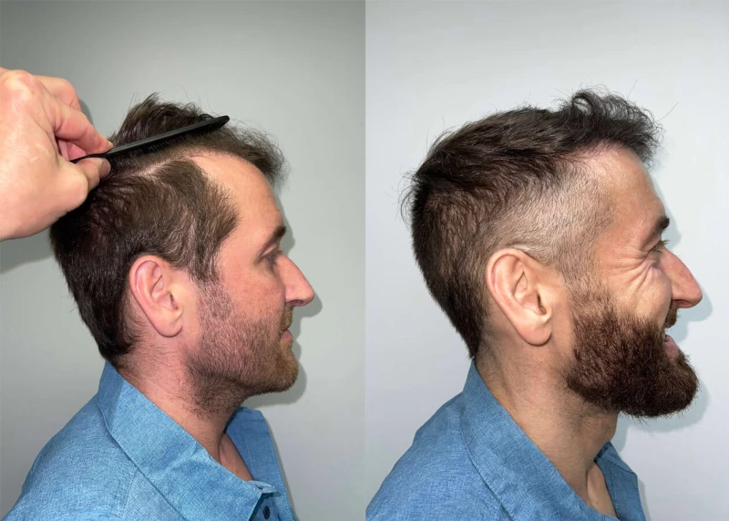 Patient p423 hair transplant before and after right view