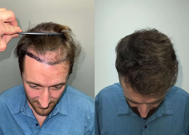 Patient p423 hair transplant before and after tilt view