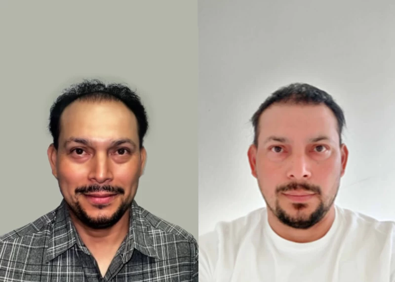 Carlos Hair Transplant Before and After