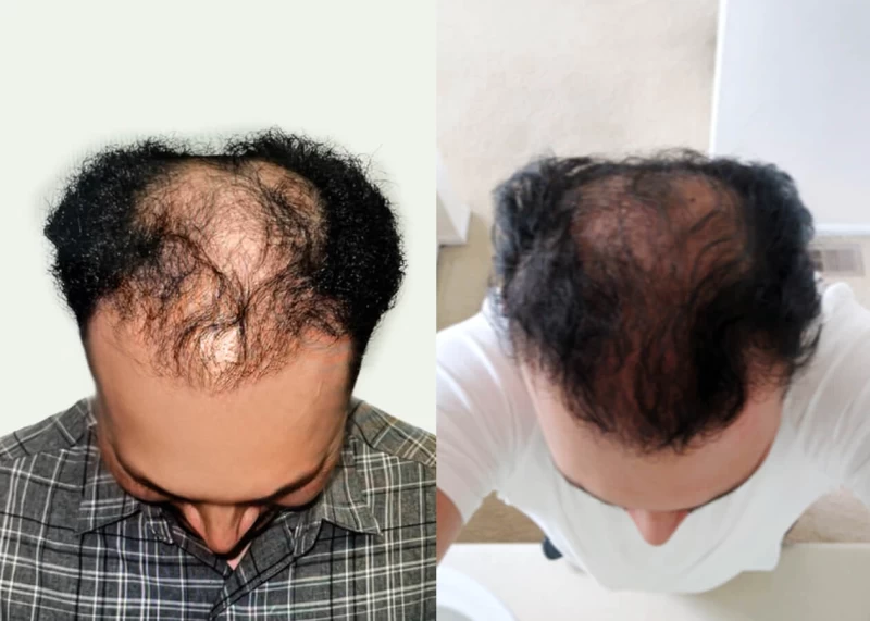 Patient p424 hair transplant before and after tilt view