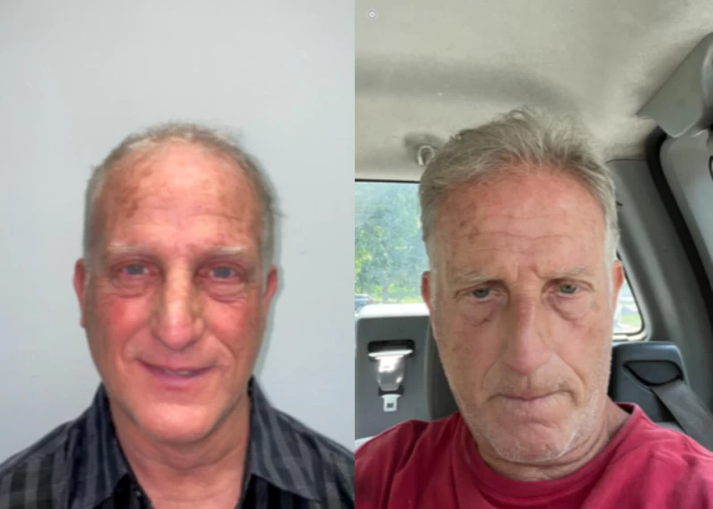 John Hair Transplant Before and After