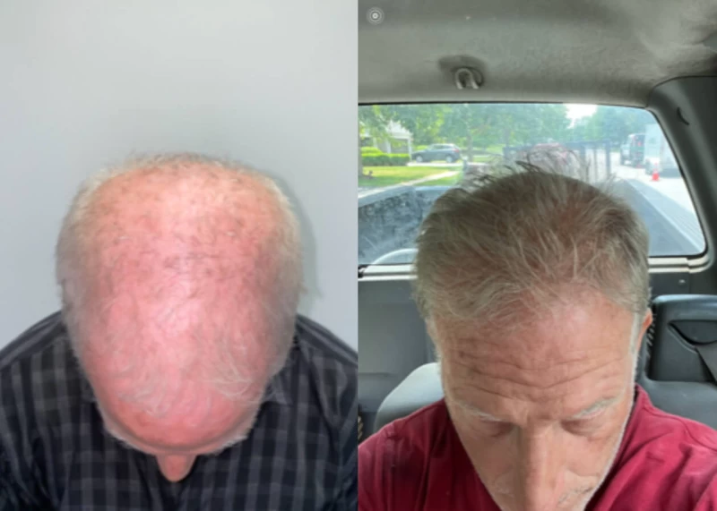 Patient p425 hair transplant before and after tilt view