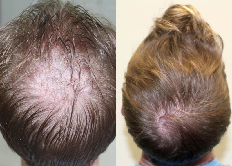 Patient p426 hair transplant before and after crown view