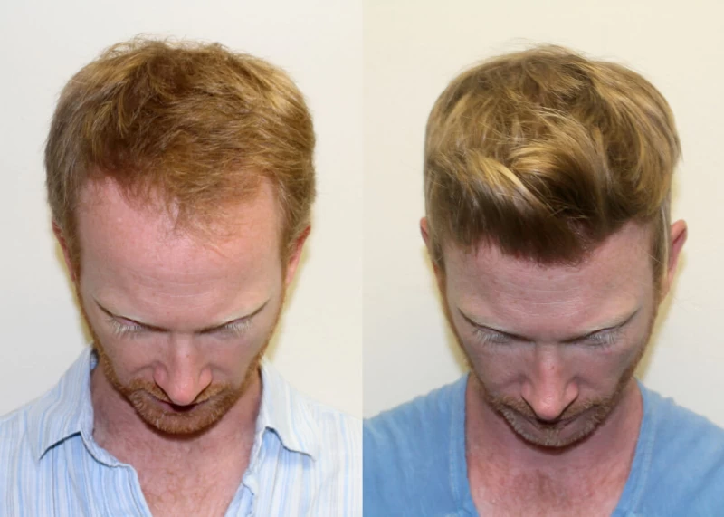 Patient 426 Hair Transplant Before and After