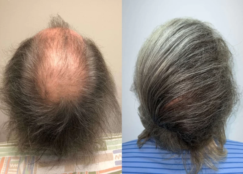 Patient p427 hair transplant before and after crown view