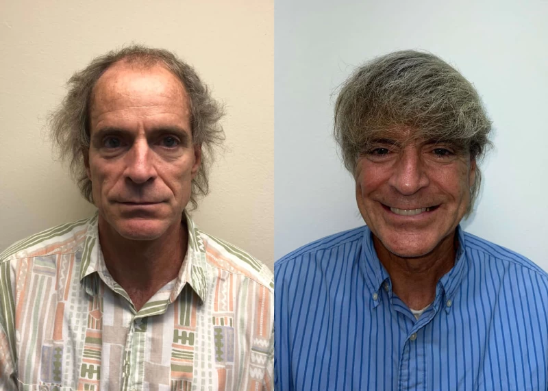 Mark Hair Transplant Before and After