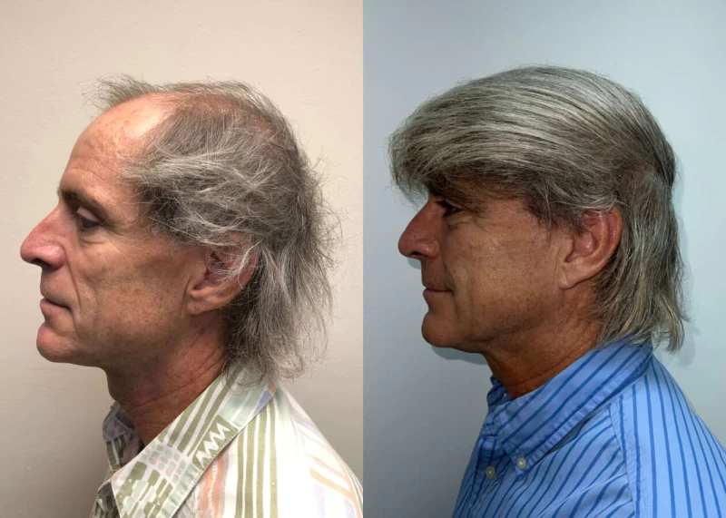 Patient p427 hair transplant before and after left view