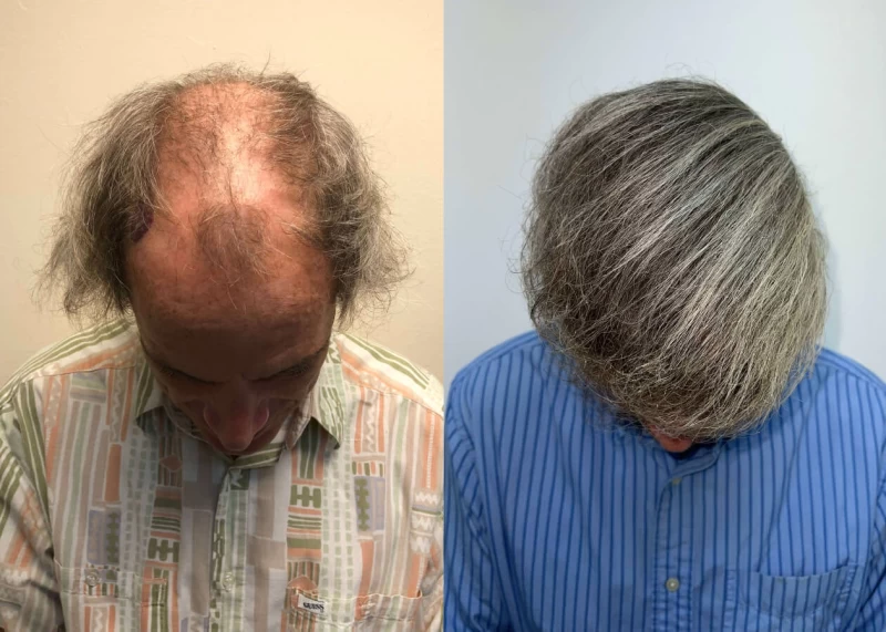 Patient p427 hair transplant before and after tilt view
