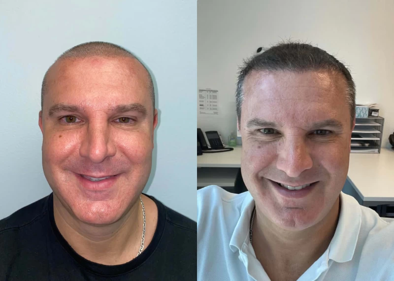 Jared Hair Transplant Before and After