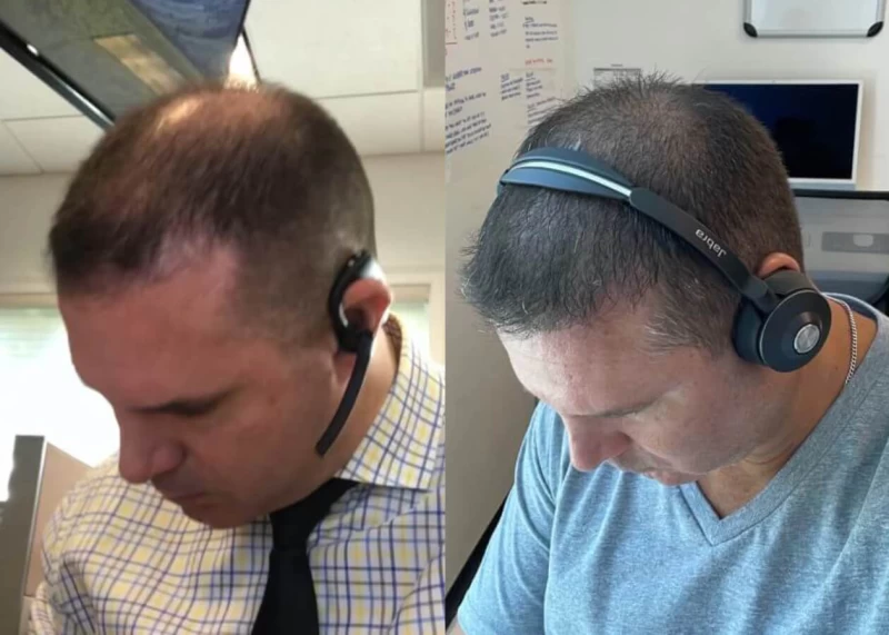 Patient p428 hair transplant before and after tilt view