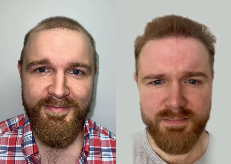 Dillion Hair Transplant Before and After