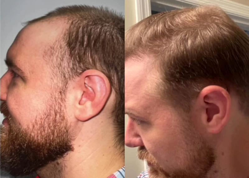 Patient p429 hair transplant before and after left view