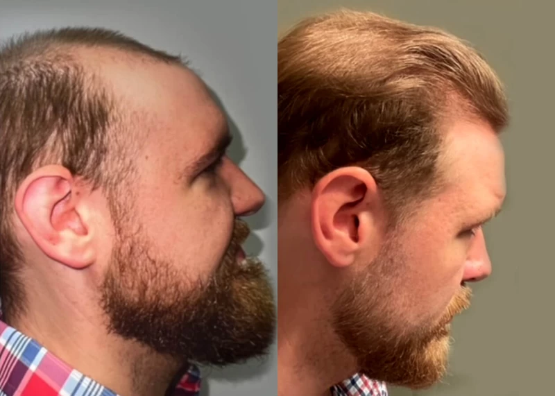 Patient p429 hair transplant before and after right view