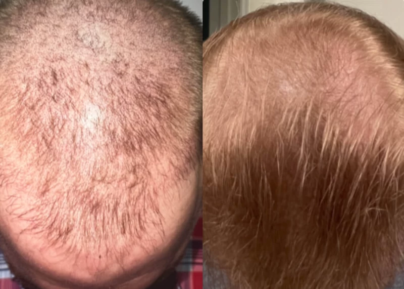 Patient p429 hair transplant before and after tilt view