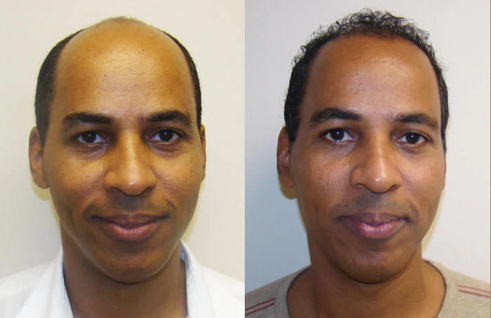 Luis Hair Transplant Before and After