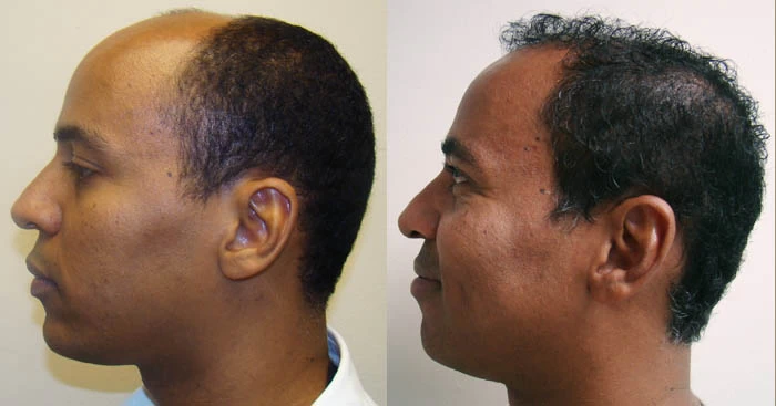 Patient p42 hair transplant before and after left view