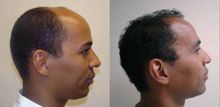 Patient p42 hair transplant before and after right view