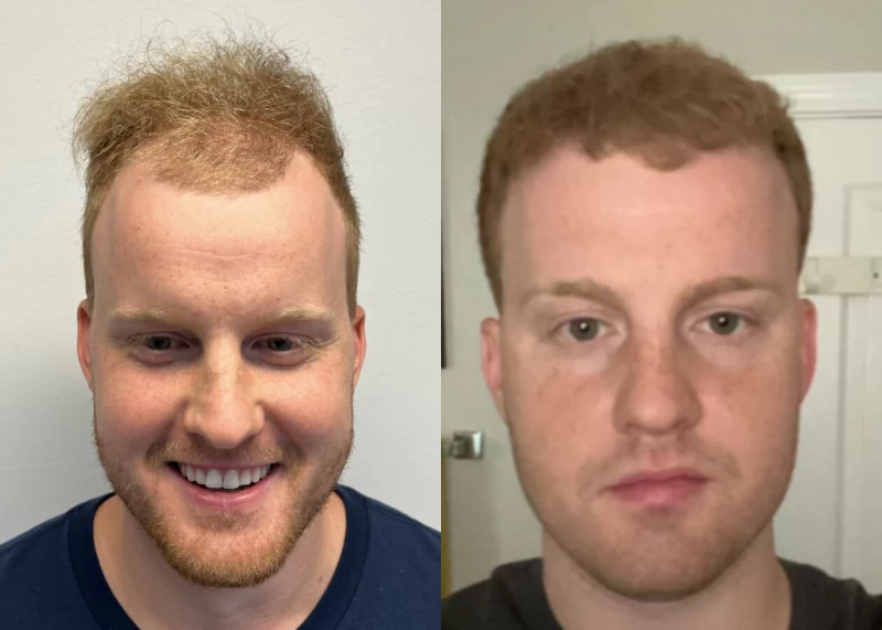 Sam Hair Transplant Before and After