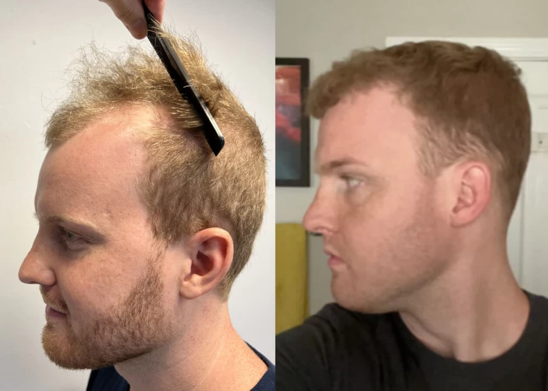 Patient p430 hair transplant before and after left view