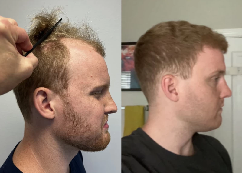 Patient p430 hair transplant before and after right view