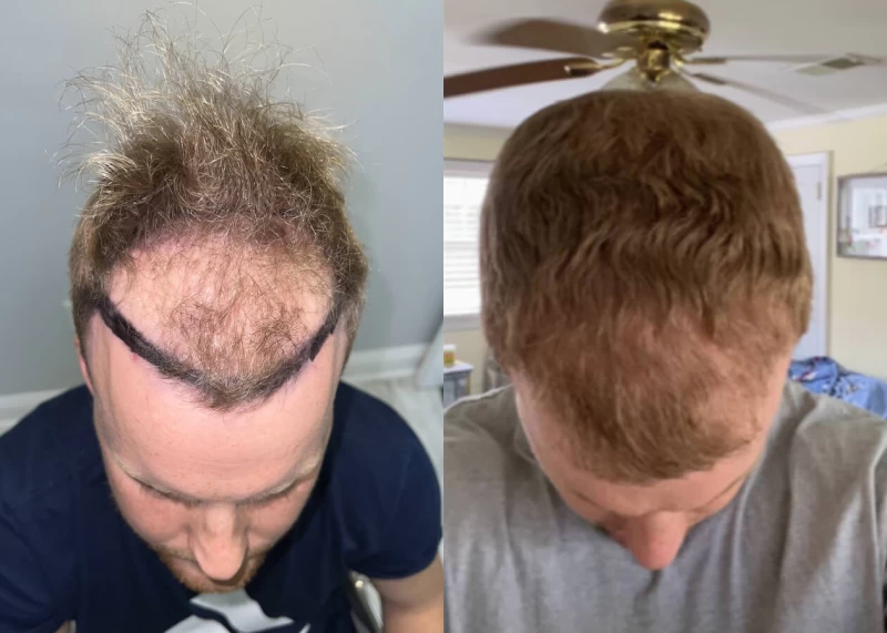 Patient p430 hair transplant before and after tilt view