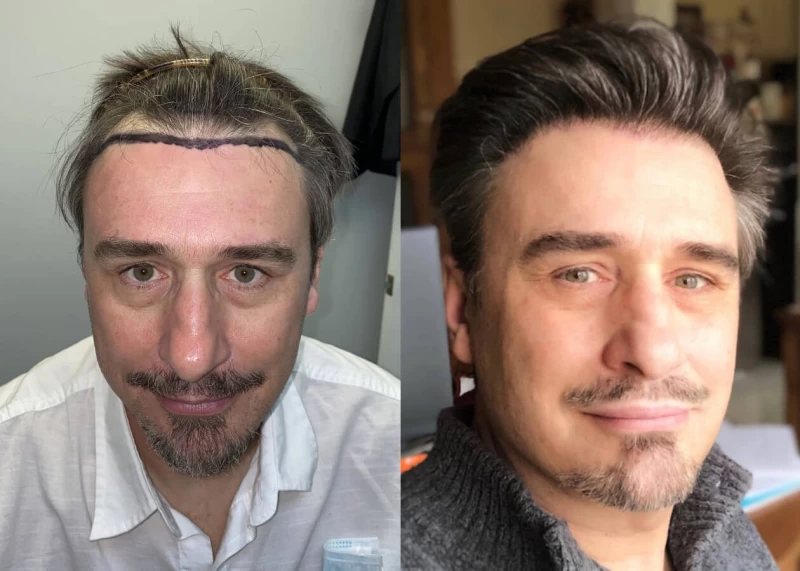 Franz Hair Transplant Before and After