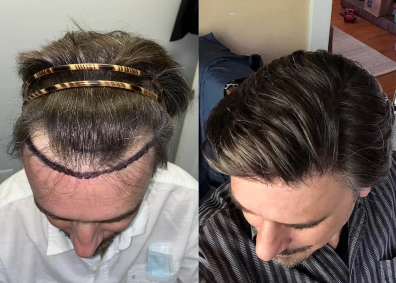 Patient p431 hair transplant before and after tilt view
