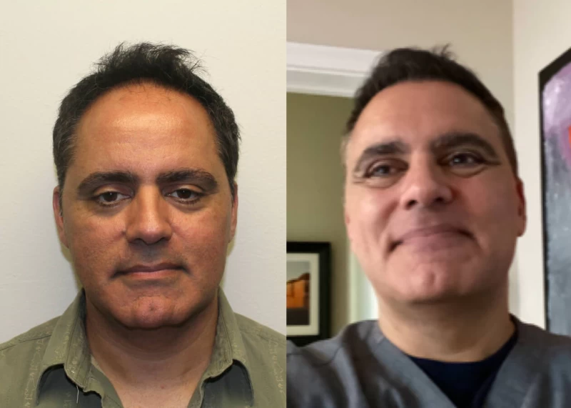 Mark Hair Transplant Before and After