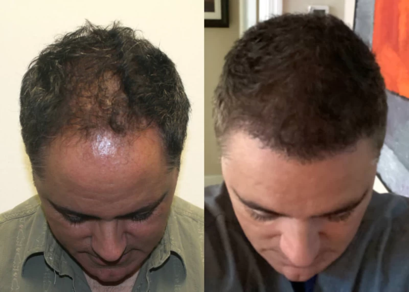 Patient p432 hair transplant before and after tilt view