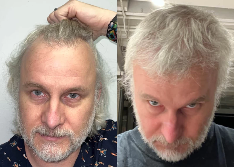 Stephen Hair Transplant Before and After