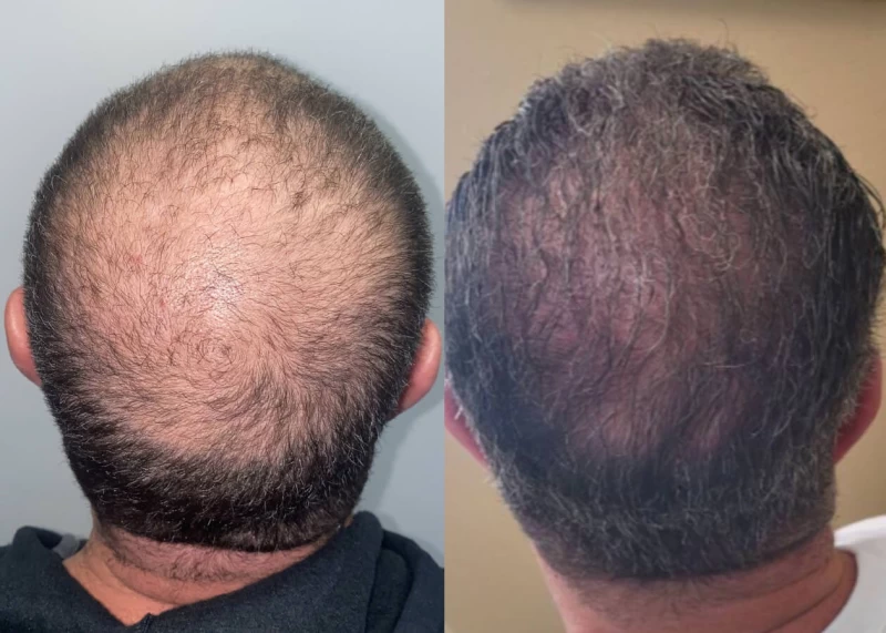Patient p434 hair transplant before and after crown view