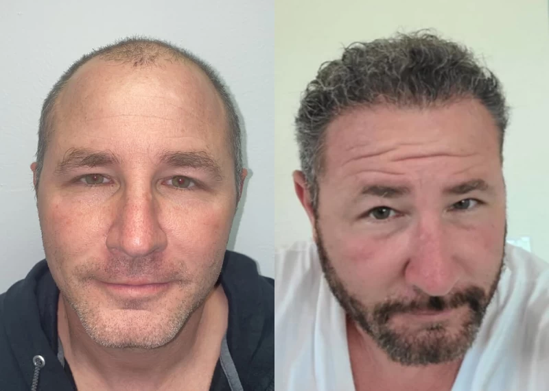 Dave Hair Transplant Before and After