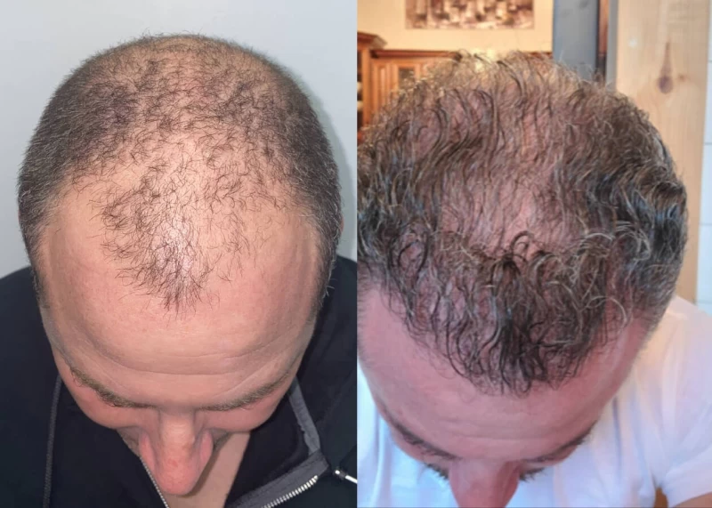 Patient p434 hair transplant before and after tilt view