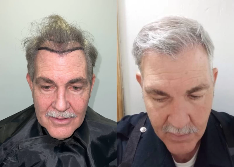 King Hair Transplant Before and After
