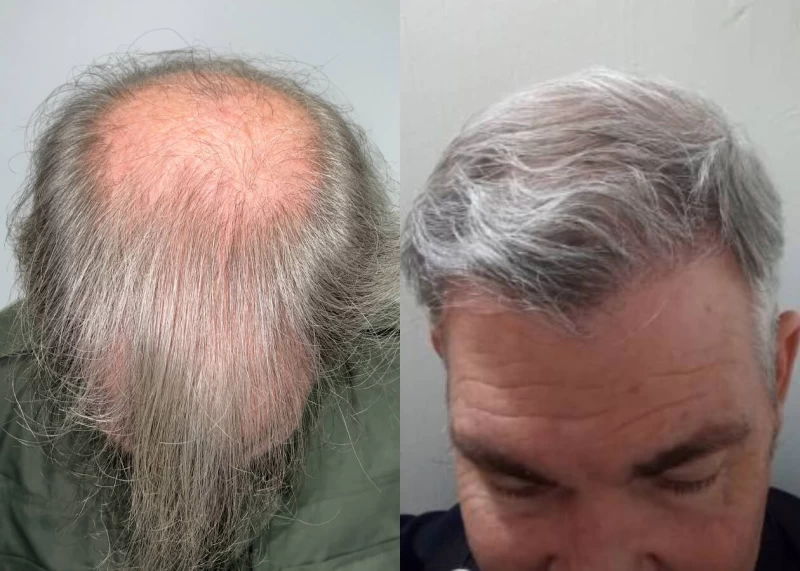 Patient p435 hair transplant before and after tilt view