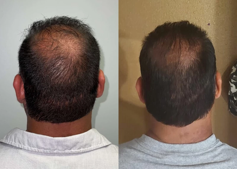 Patient p436 hair transplant before and after crown view