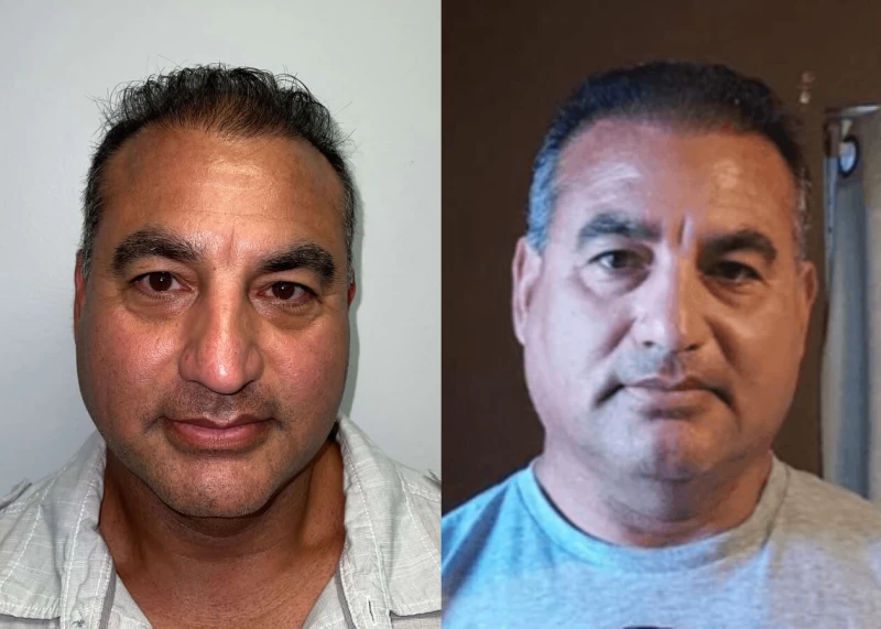 Bobby Hair Transplant Before and After