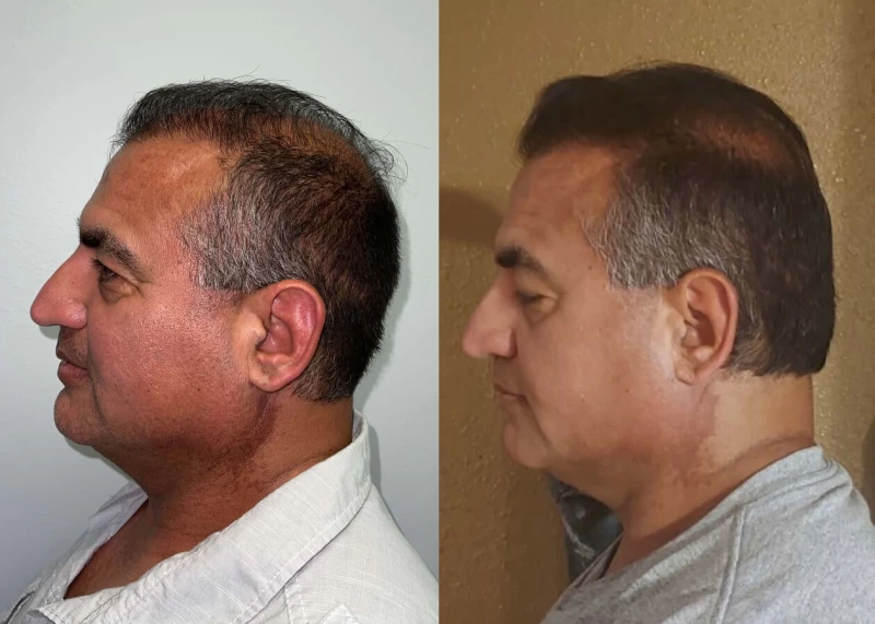 Patient p436 hair transplant before and after left view