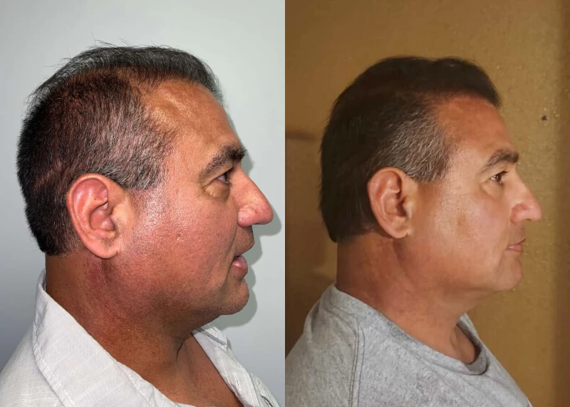 Patient p436 hair transplant before and after right view