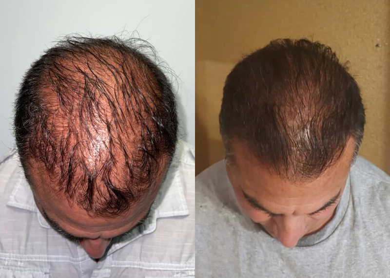 Patient p436 hair transplant before and after tilt view