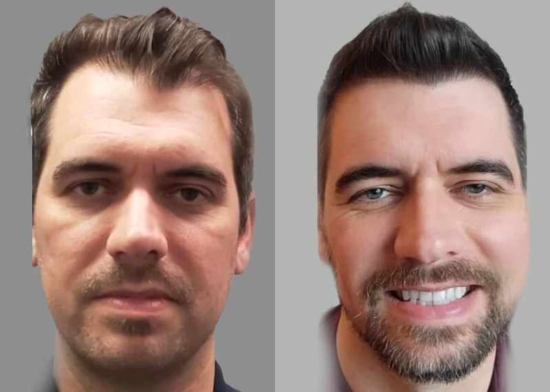 Jamie Hair Transplant Before and After