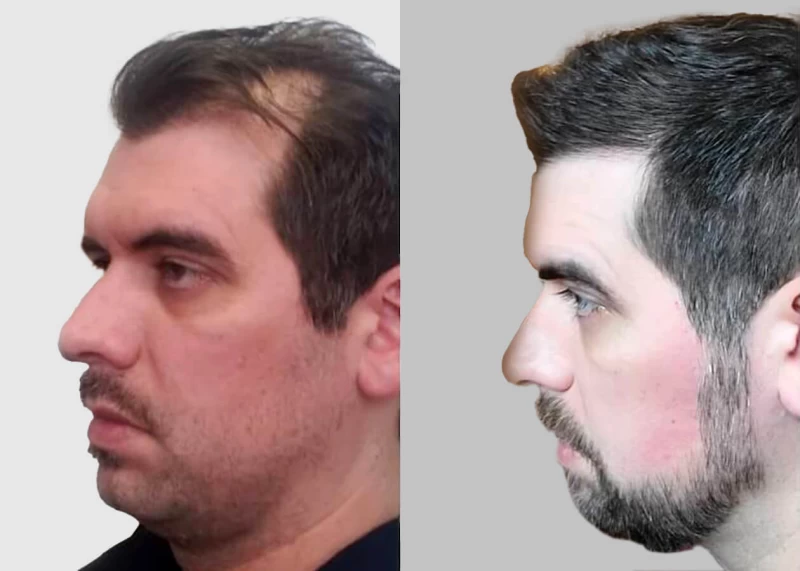 Patient p437 hair transplant before and after left view